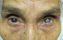 Первые признаки начальной катаракты
